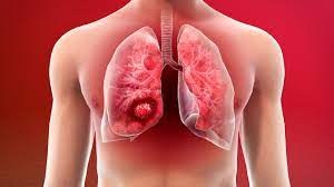 lung Cancer Specialist in Nepal