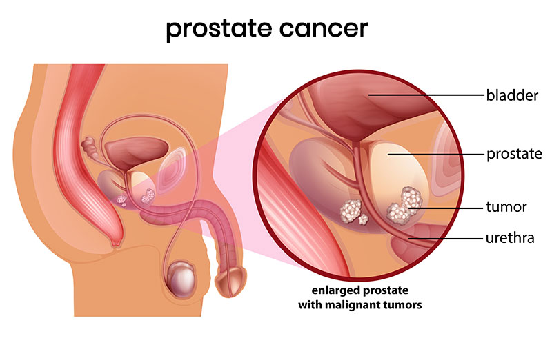 prostate cancer specialist in nepal